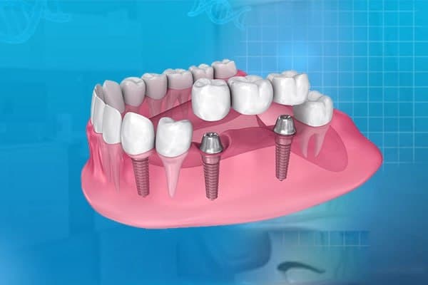 دندانپزشکی تخصصی ایمپلنت دیجیتال